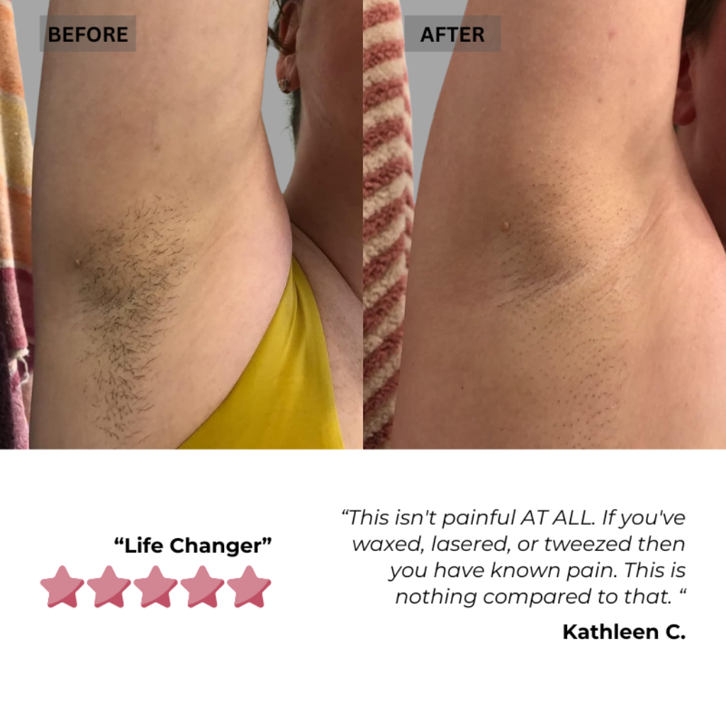 Before and after photos of IPL hair removal on the bikini line, illustrating noticeable hair reduction results