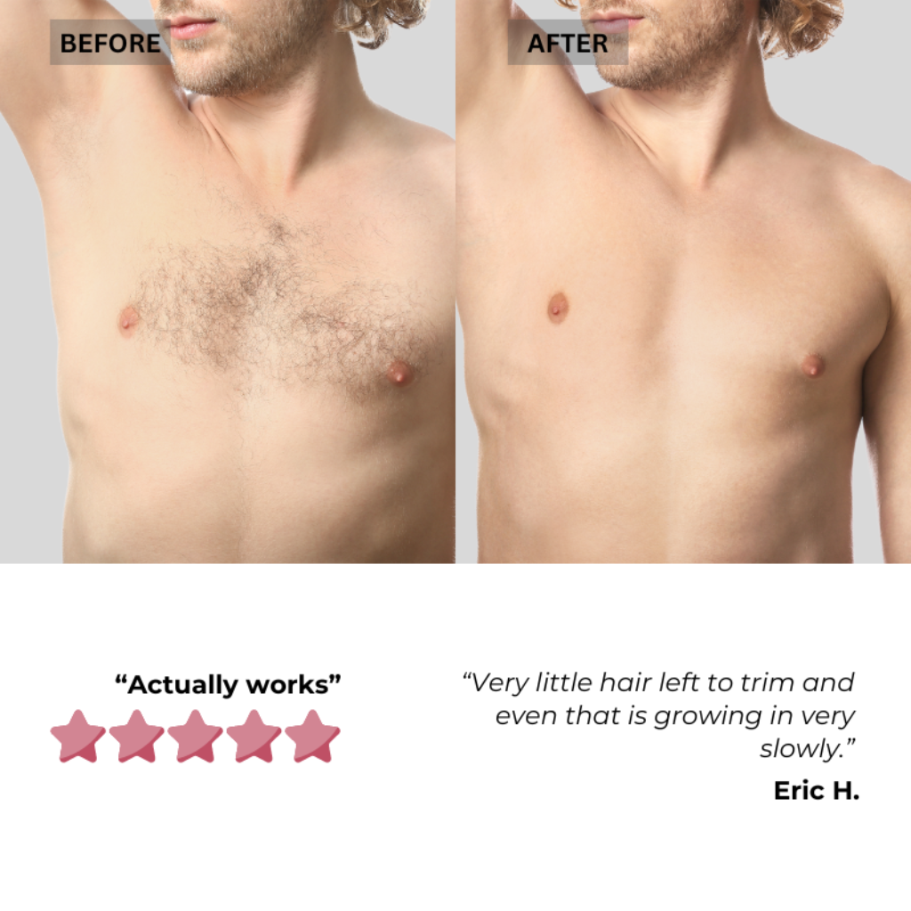 Before and after comparison of IPL hair removal on the male chest, showing significant hair reduction