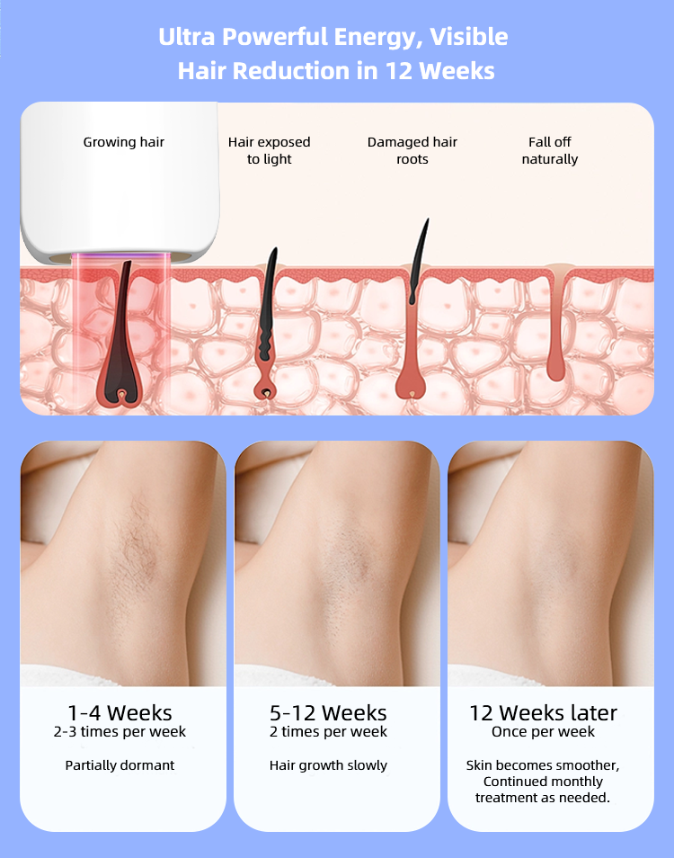 Chart demonstrating the progress of IPL hair removal treatment over 12 weeks, highlighting visible reduction in hair growth.